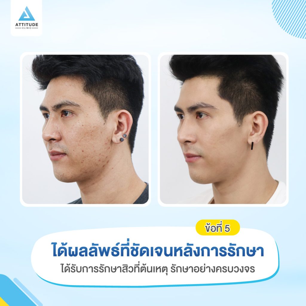 5 ข้อดี เมื่อมารักษาสิวที่ Attitude Clinic ได้อะไรบ้าง ? หมออยู่ทุกวัน ดูแลเองทุกเคส รักษาสิวครบวงจร สิวหายจริง ไม่เลี้ยงไข้ สิวหายแล้วกว่า 5000 เคส รีวิวรักษาสิวเยอะที่สุดที่ Attitude Clinic เชียงราย เชียงใหม่ ลำปาง