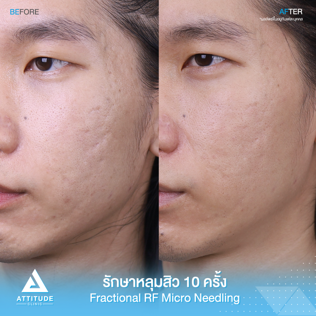 รีวิวรักษาหลุมสิว เห็นผลตั้งแต่ครั้งแรกที่ทำ 20% โปรแกรม FRF -Fractional Microneedle RF จำนวน 10 ครั้ง รักษาแล้ว 3 in 1 หลุมสิวดีขึ้น ผิวเรียบเนียน รูขุมขนกระชับ ที่ Attitude Clinic สาขาเชียงราย เชียงใหม่ ลำปาง