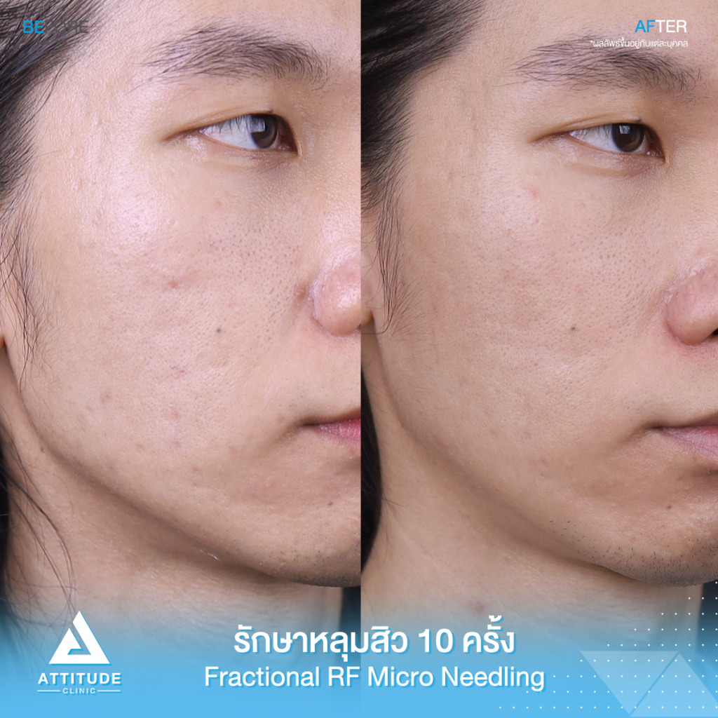 รีวิวรักษาหลุมสิว เห็นผลตั้งแต่ครั้งแรกที่ทำ 20% โปรแกรม FRF -Fractional Microneedle RF จำนวน 10 ครั้ง รักษาแล้ว 3 in 1 หลุมสิวดีขึ้น ผิวเรียบเนียน รูขุมขนกระชับ ที่ Attitude Clinic สาขาเชียงราย เชียงใหม่ ลำปาง