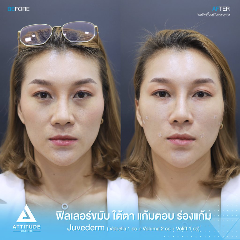 รีวิวฉีดฟิลเลอร์ juvederm บริเวณขมับ ใต้ตา แก้มตอบ ร่องแก้ม ด้วยฟิลเลอร์ ???????? ??????? ? ??, ??????  ? ?? และ ?????? ? ?? ของคุณจอย สวยอย่างเป็นธรรมชาติ ที่ ???????? ?????? สาขาเชียงราย เชียงใหม่ ลำปาง