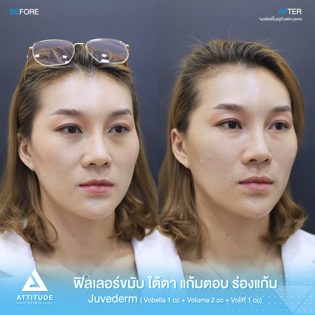 รีวิวฉีดฟิลเลอร์ juvederm บริเวณขมับ ใต้ตา แก้มตอบ ร่องแก้ม ด้วยฟิลเลอร์ ???????? ??????? ? ??, ??????  ? ?? และ ?????? ? ?? ของคุณจอย สวยอย่างเป็นธรรมชาติ ที่ ???????? ?????? สาขาเชียงราย เชียงใหม่ ลำปาง