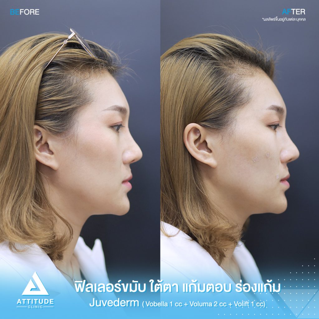 รีวิวฉีดฟิลเลอร์ juvederm บริเวณขมับ ใต้ตา แก้มตอบ ร่องแก้ม ด้วยฟิลเลอร์ ???????? ??????? ? ??, ??????  ? ?? และ ?????? ? ?? ของคุณจอย สวยอย่างเป็นธรรมชาติ ที่ ???????? ?????? สาขาเชียงราย เชียงใหม่ ลำปาง