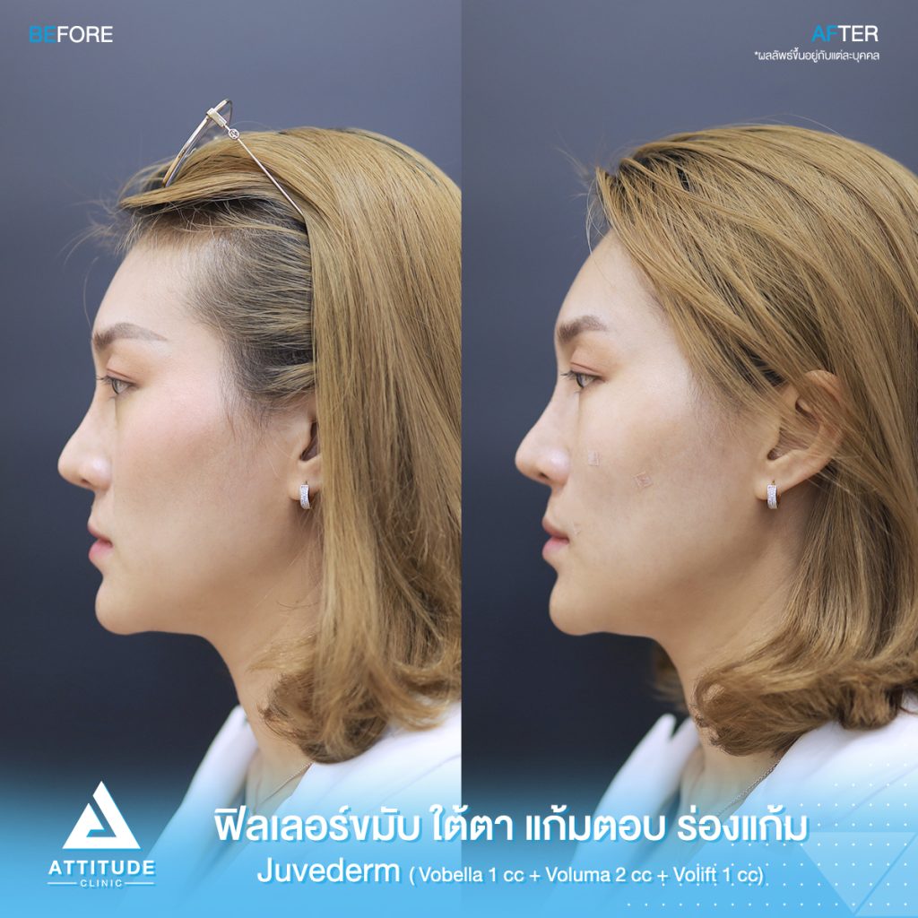 รีวิวฉีดฟิลเลอร์ juvederm บริเวณขมับ ใต้ตา แก้มตอบ ร่องแก้ม ด้วยฟิลเลอร์ ???????? ??????? ? ??, ??????  ? ?? และ ?????? ? ?? ของคุณจอย สวยอย่างเป็นธรรมชาติ ที่ ???????? ?????? สาขาเชียงราย เชียงใหม่ ลำปาง