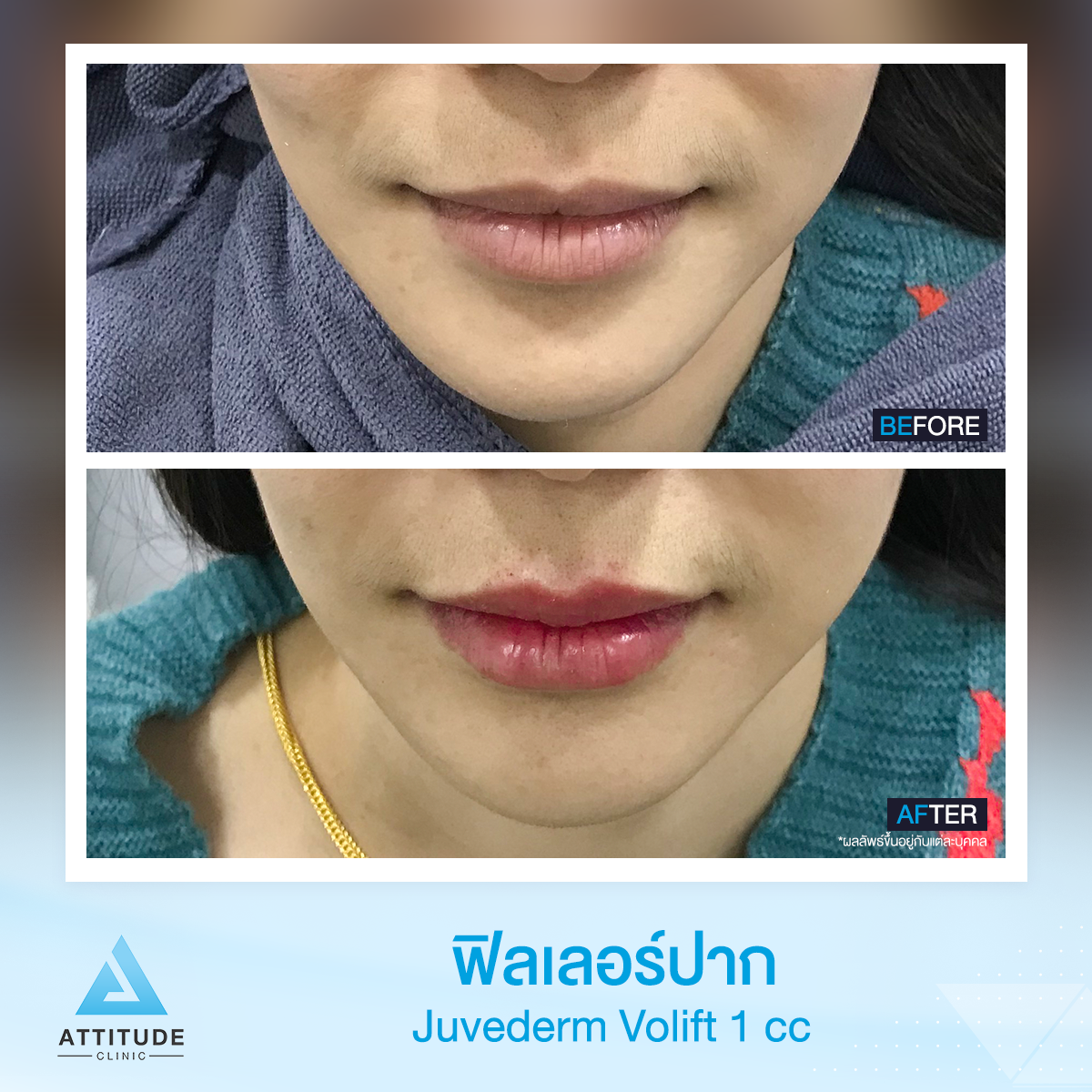 รีวิวฉีดฟิลเลอร์ปาก Juvederm Volift จำนวน 1 cc เติมเต็มปรับรูปปากให้สวย อวบอิ่ม แบบเป็นธรรมชาติที่ Attitude Clinic