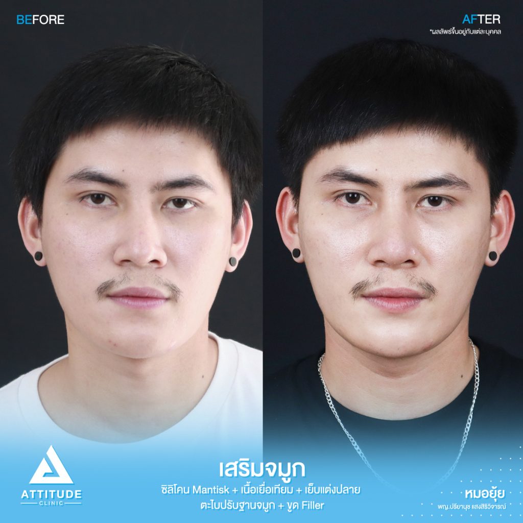 รีวิวเสริมจมูกผู้ชาย