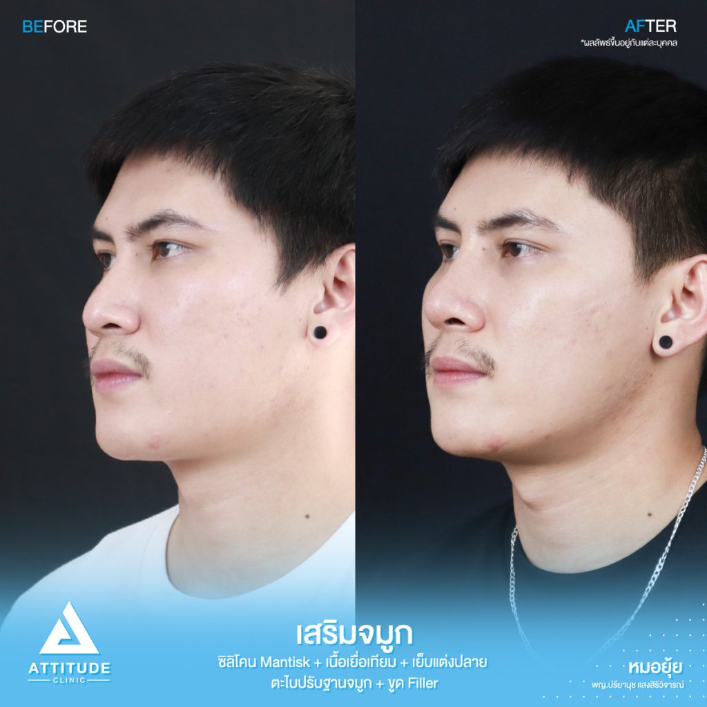 รีวิวเสริมจมูกผู้ชาย