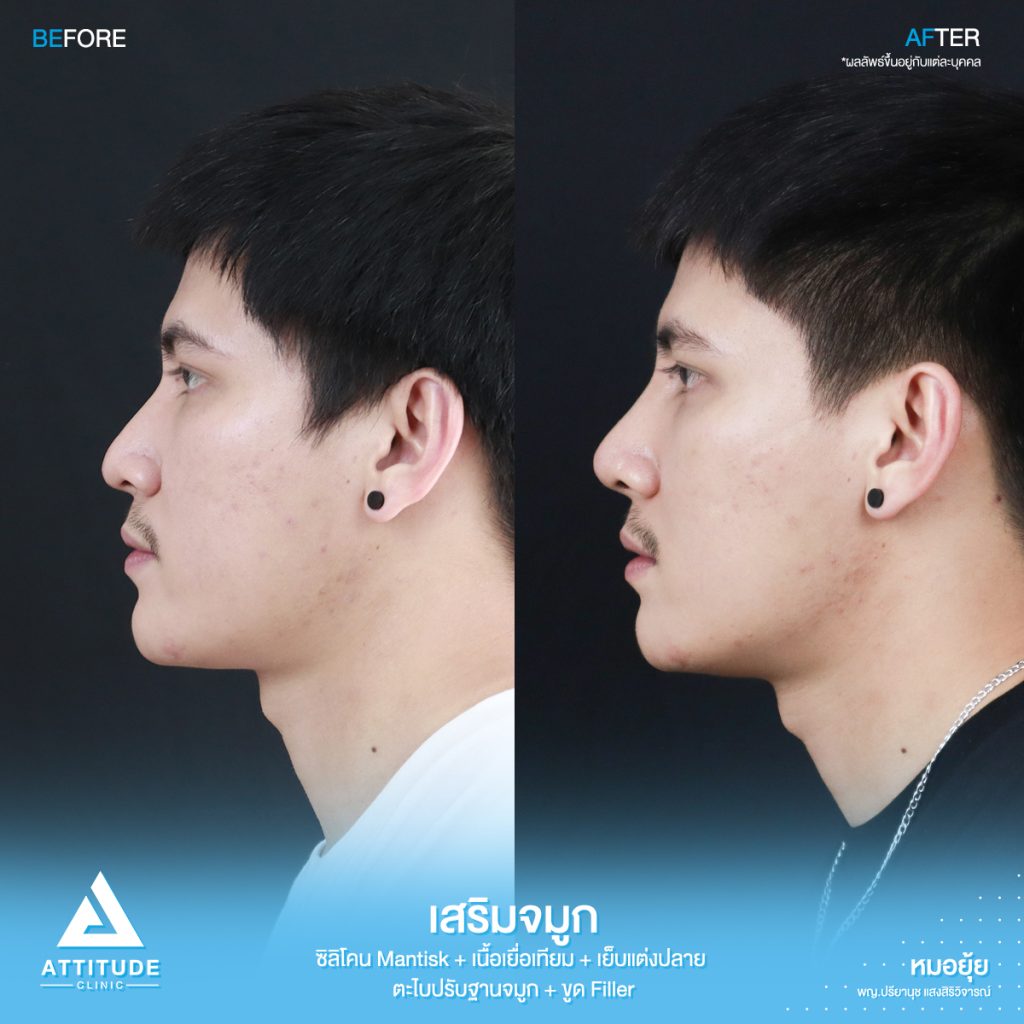 รีวิวเสริมจมูกผู้ชาย