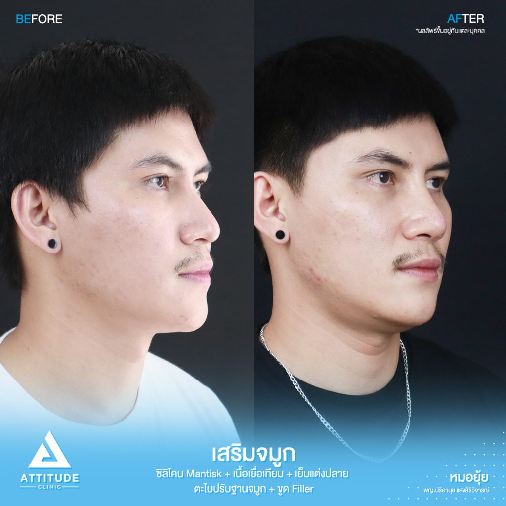 รีวิวเสริมจมูกผู้ชาย