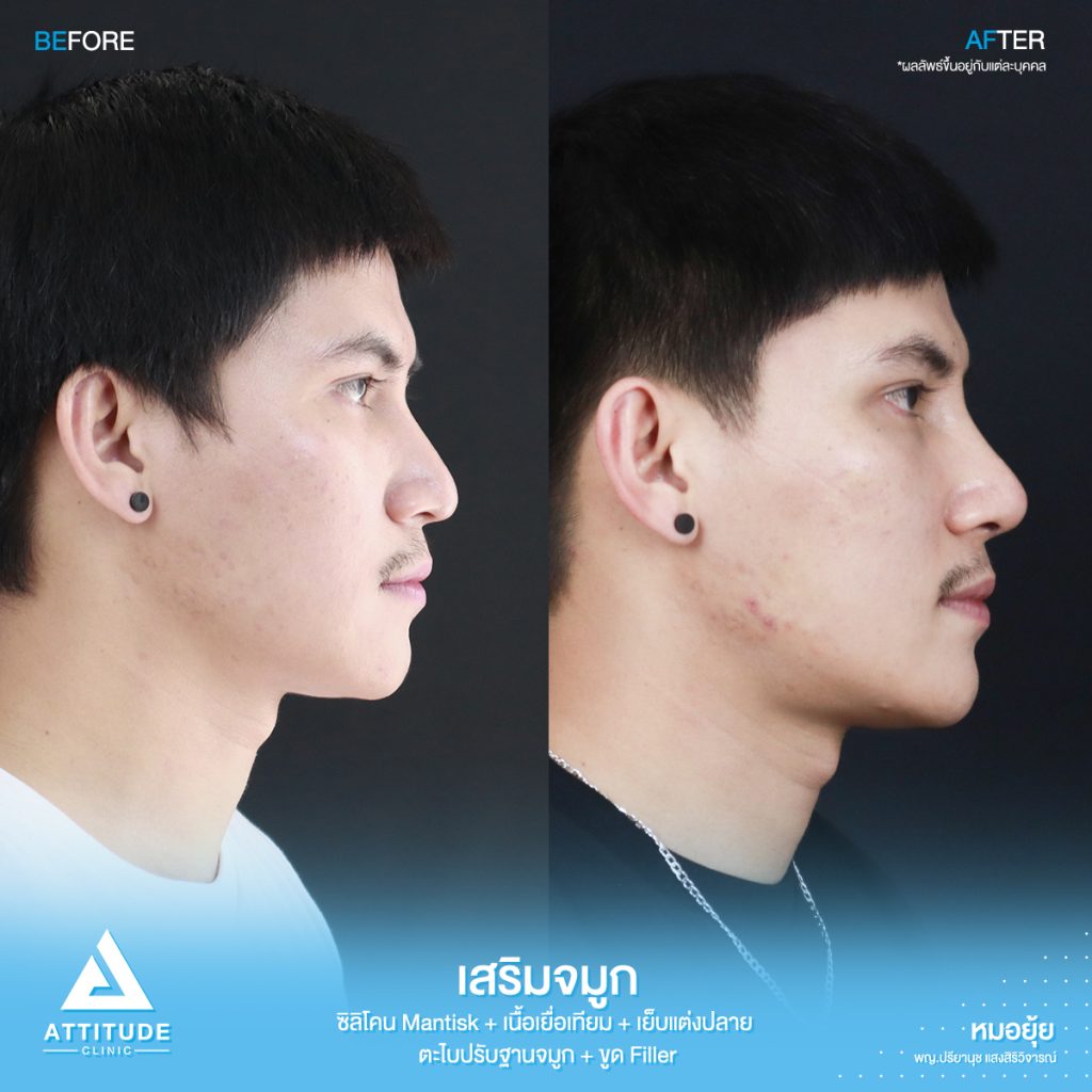 รีวิวเสริมจมูกผู้ชาย