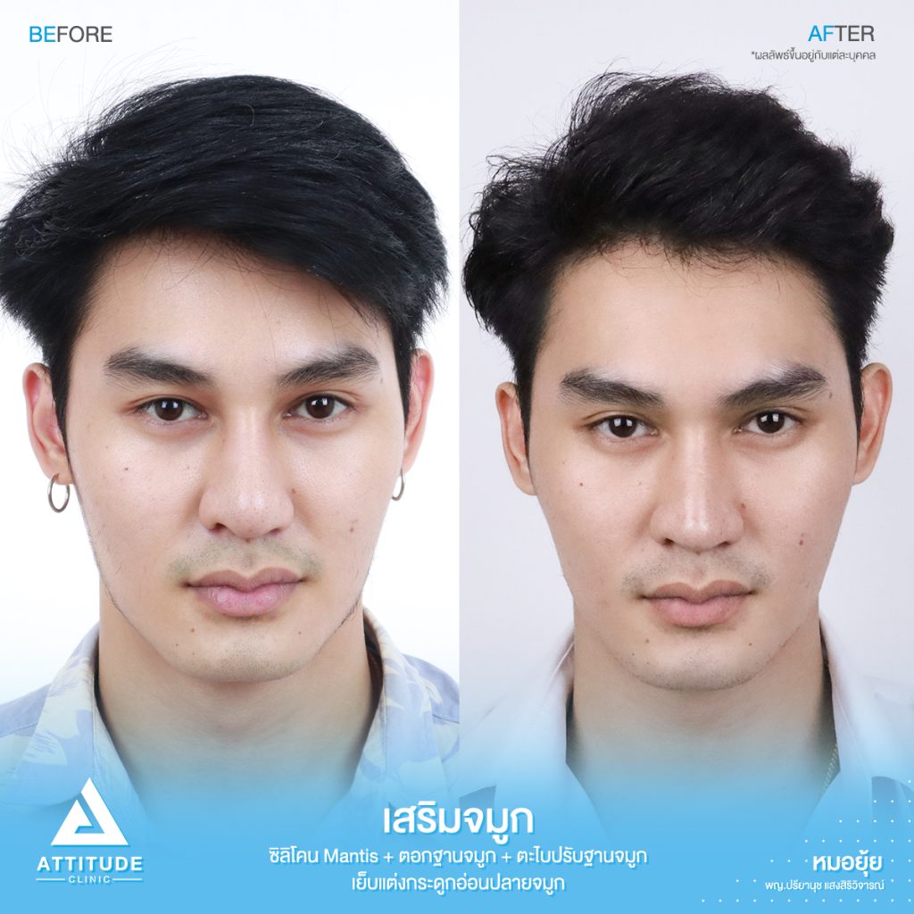 รีวิวเสริมจมูกผู้ชาย