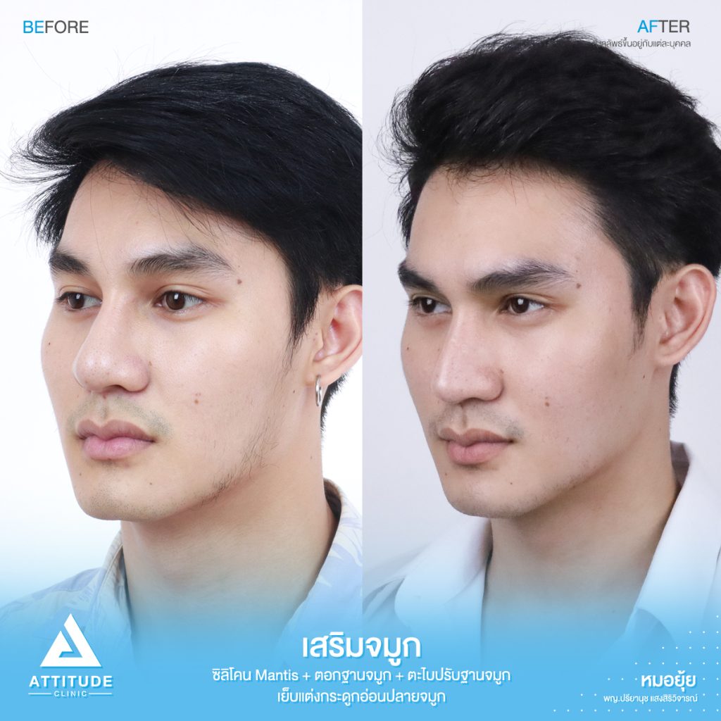 รีวิวเสริมจมูกผู้ชาย