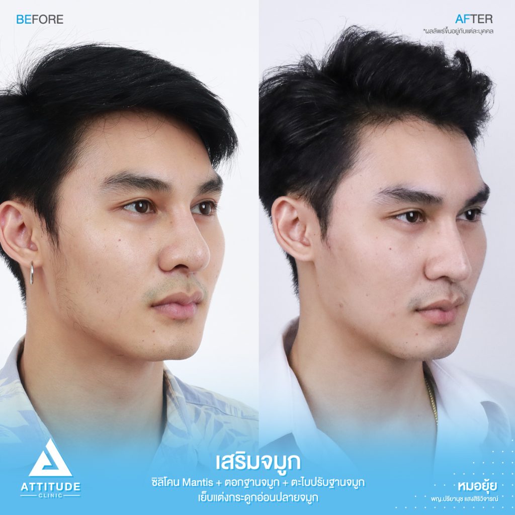 รีวิวเสริมจมูกผู้ชาย