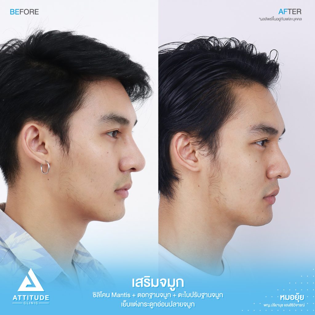 รีวิวเสริมจมูกผู้ชาย