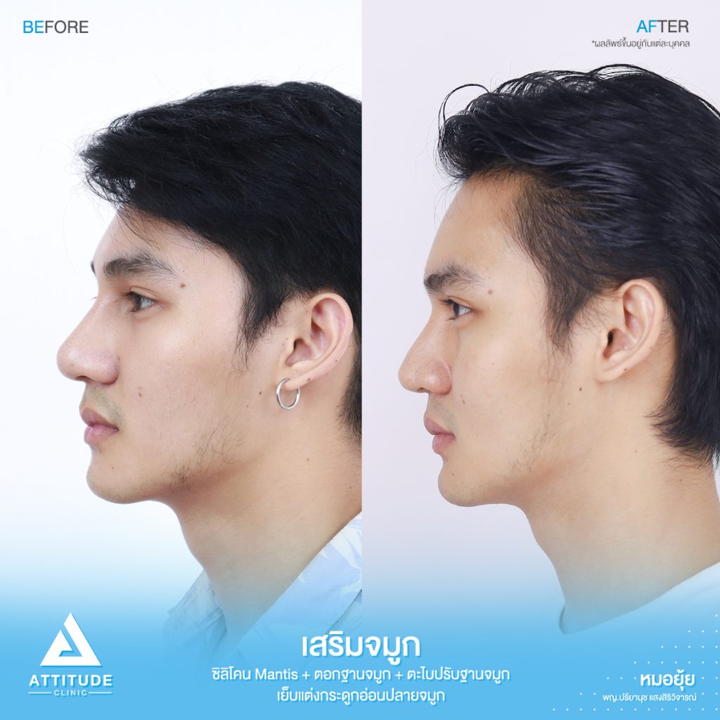 รีวิวเสริมจมูกผู้ชาย