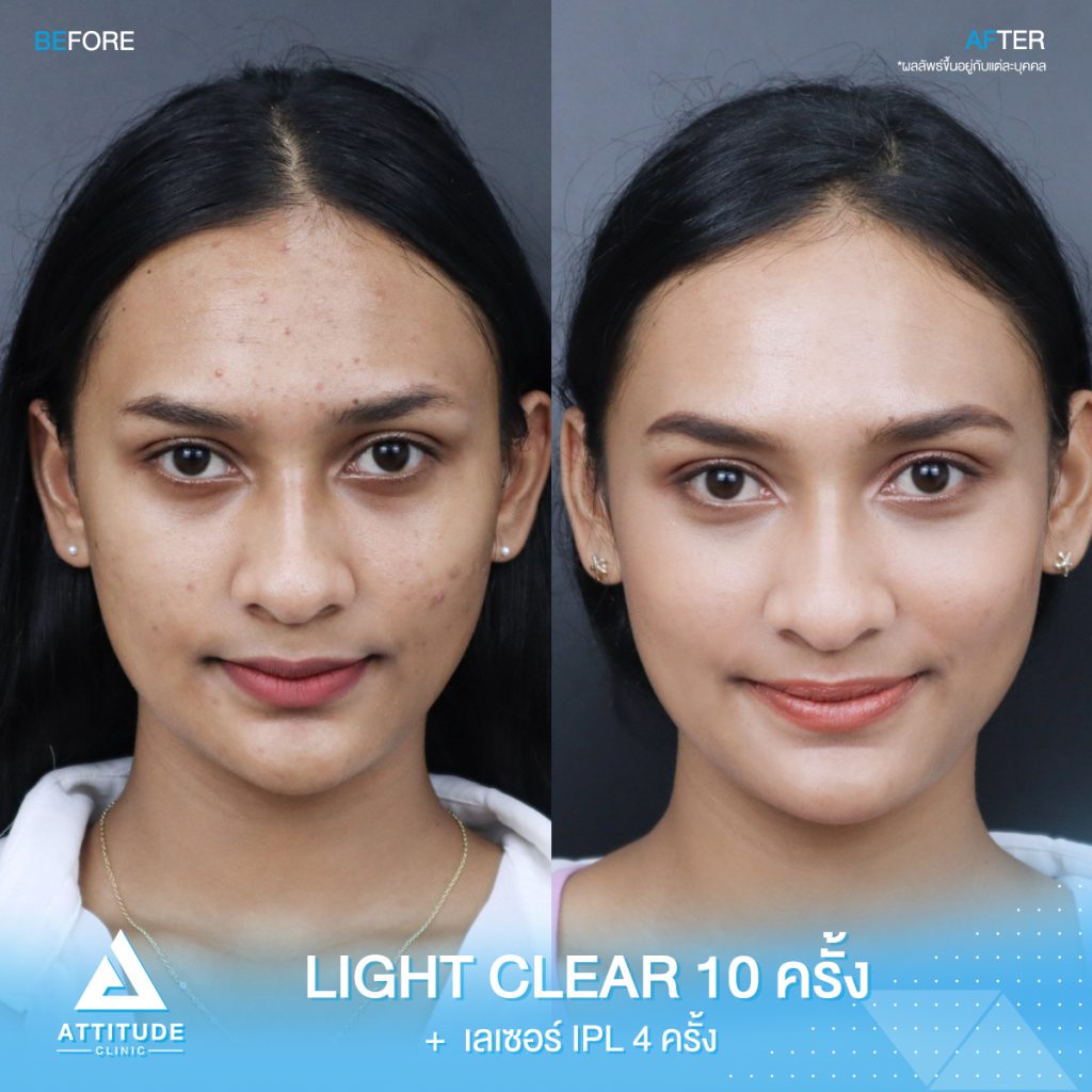 รีวิวรักษาสิวด้วยการฉายแสง 7 ขั้นตอนโปรแกรม Light Clearจำนวน 10 ครั้ง และเลเซอร์หน้าใส IPL จำนวน 4 ครั้ง ของน้องซอฟียะห์ ที่มีปัญหาสิวอุดตัน สิวอักเสบ สิวฮอร์โมน และรอยแดง รอยดำจากสิวรักษาสิวครบวงจร ที่ Attitude Clinic สาขาเชียงราย เชียงใหม่ ลำปาง