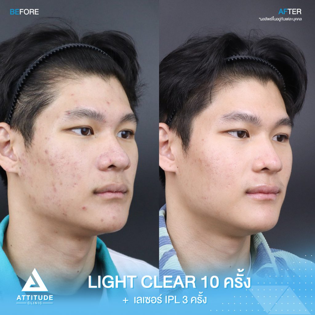 รีวิวรักษาสิวด้วยการฉายแสง ? ขั้นตอนโปรแกรม Light Clear 10 ครั้ง และเลเซอร์หน้าใส IPL 3 ครั้ง ของน้องคิม ที่มีปัญหาสิวอุดตัน สิวอักเสบ สิวฮอร์โมน และรอยแดง รอยดำจากสิว รักษาสิวควบวงจร ที่ Attitude Clinic เชียงราย เชียงใหม่ ลำปาง รีวิวเพียบ