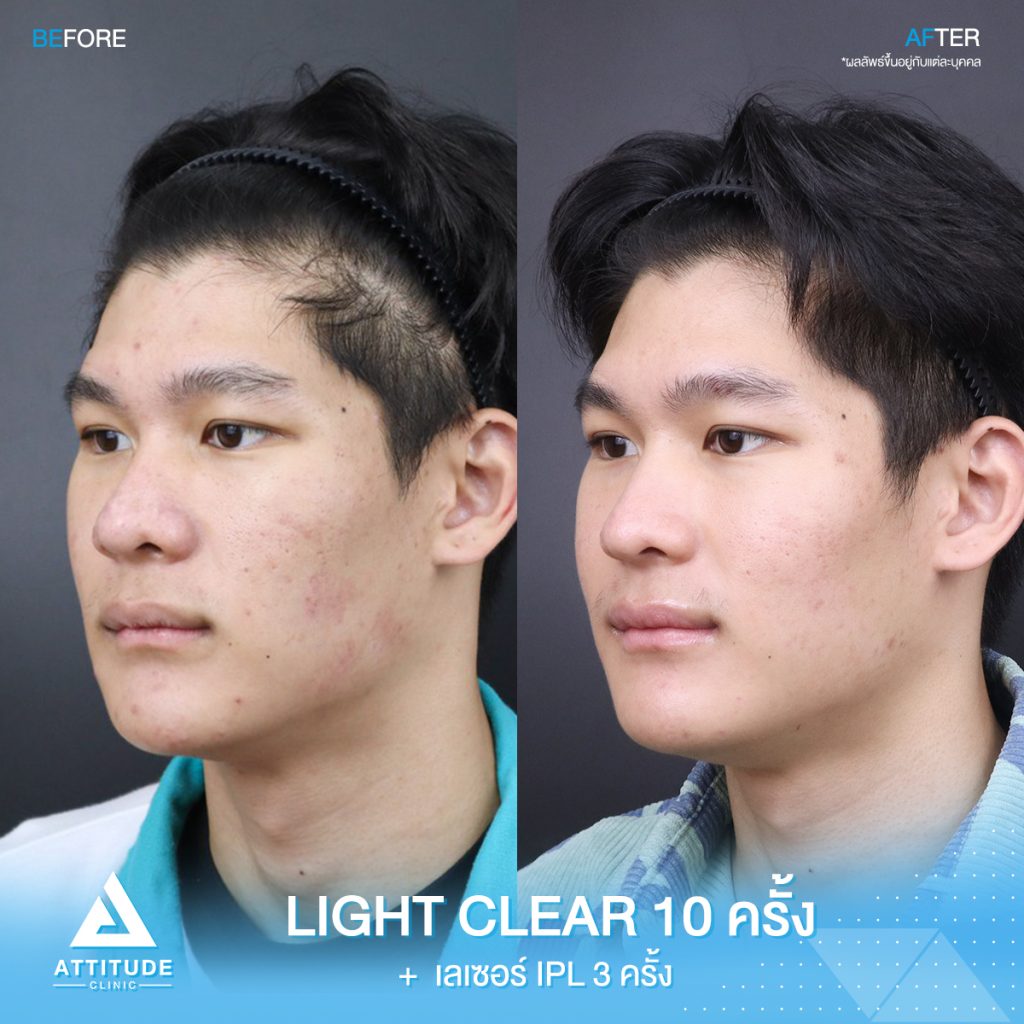 รีวิวรักษาสิวด้วยการฉายแสง ? ขั้นตอนโปรแกรม Light Clear 10 ครั้ง และเลเซอร์หน้าใส IPL 3 ครั้ง ของน้องคิม ที่มีปัญหาสิวอุดตัน สิวอักเสบ สิวฮอร์โมน และรอยแดง รอยดำจากสิว รักษาสิวควบวงจร ที่ Attitude Clinic เชียงราย เชียงใหม่ ลำปาง รีวิวเพียบ