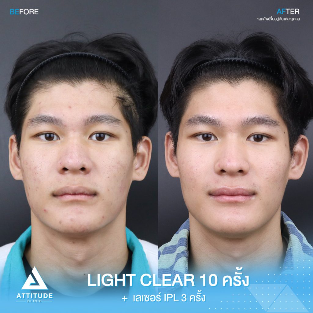 รีวิวรักษาสิวครบวงจร รักษาสิวด้วยการฉายแสง ? ขั้นตอนโปรแกรม Light Clear 10 ครั้ง และเลเซอร์หน้าใส IPL 3 ครั้ง ของน้องคิม ที่มีปัญหาสิวอุดตัน สิวอักเสบ สิวฮอร์โมน และรอยแดง รอยดำจากสิวที่ Attitude Clinic เชียงราย เชียงใหม่ ลำปาง รีวิวเพียบ