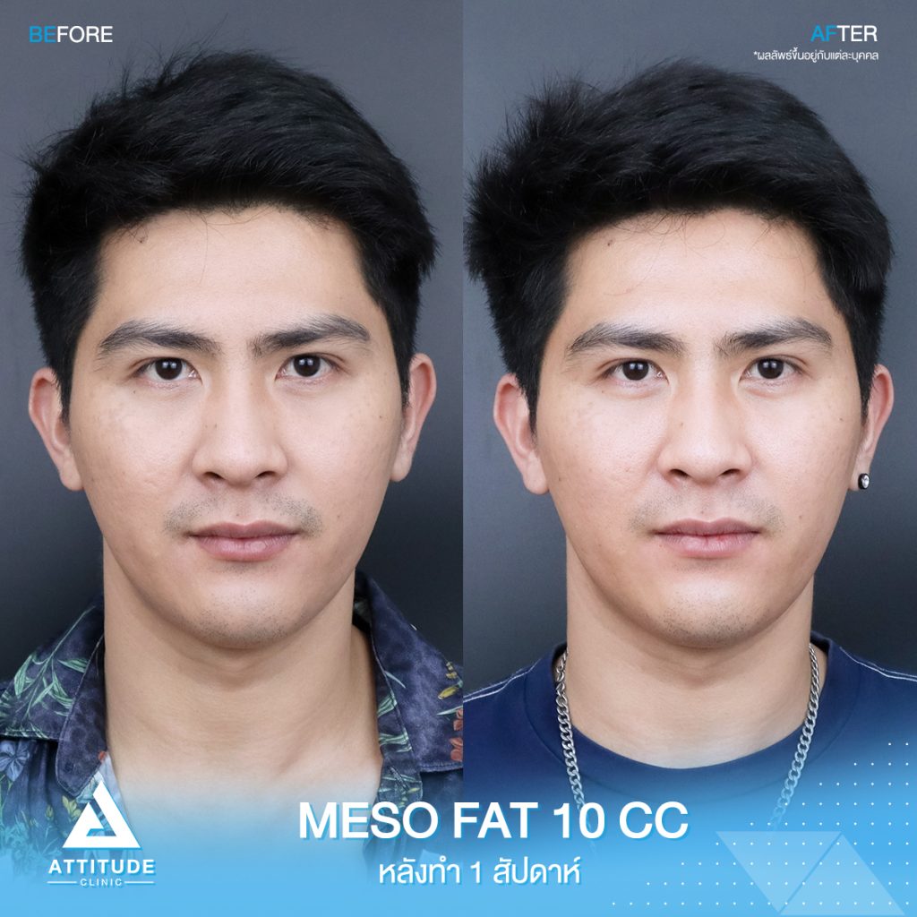 รีวิวฉีด MesoFat สลายไขมัน รีวิวฉีดเมโสแฟตลดเหนียง จำนวน 10 cc ของคุณเกมโกะ เสริมหล่อ เติมความมั่นใจ เตรียมหน้าให้พร้อมรับงานถ่ายแบบ เดินแบบ หันมุมไหนก็มั่นใจเกินร้อยที่ Attitude Clinic เชียงใหม่ ลำปาง เชียงราย รีวิวฉีดเมโสแฟตลดเหนียง