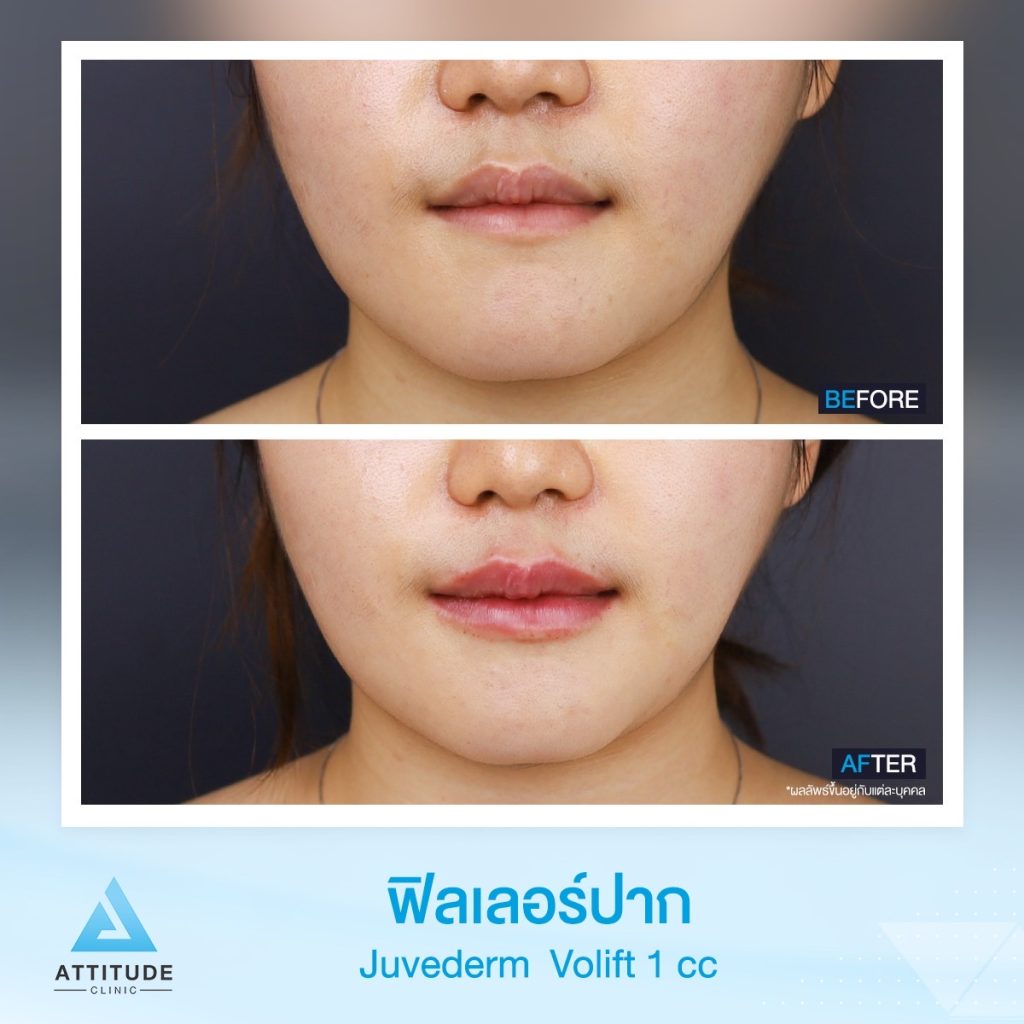 รูปรีวิวฉีดฟิลเลอร์ปาก