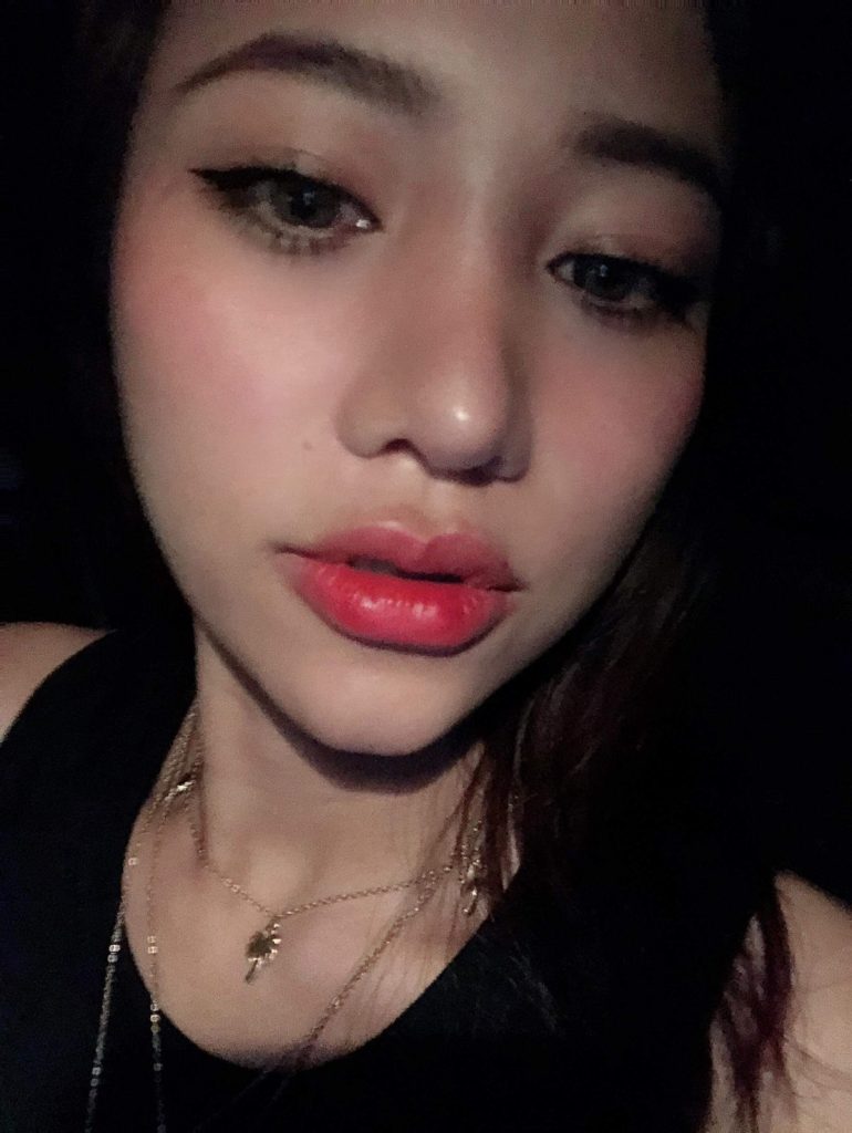รูปรีวิวฉีดฟิลเลอร์ปาก
