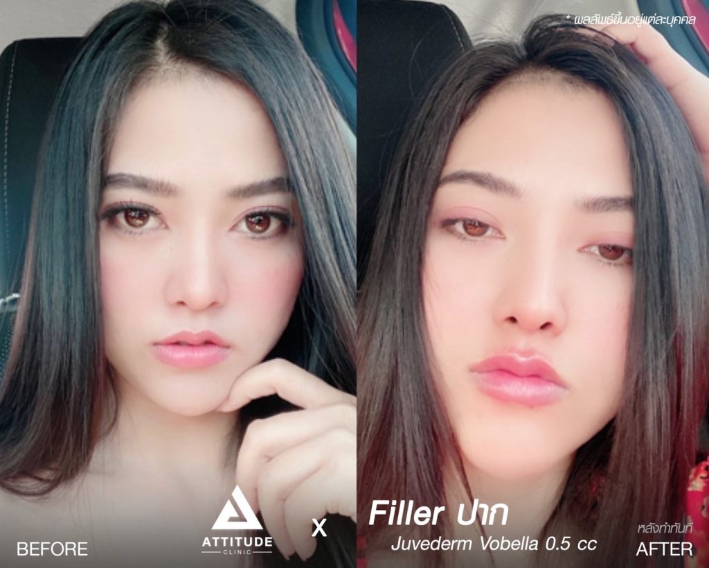 รูปรีวิวฉีดฟิลเลอร์ปาก