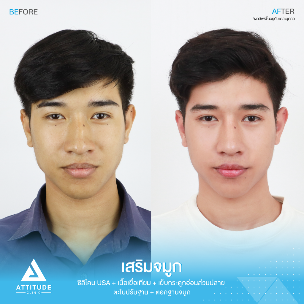 รีวิวเสริมจมูกผู้ชาย ด้วยซิลิโคน Mantisk ปรับฐานกระดูกสูกฮัพม์จมูกใหญ่ ให้เรียบโดยหมอยุ้ย Attitude Clinic รัชดา ของน้องออโต้ มีฐานกระดูกจมูกค่อนข้างสูง (ส่วนกลาง) หรือฮัมพ์ มุมหน้าตรงอาจจะดูว่ามีสันจมูกอยู่แล้ว ส่วนมุมหันข้างจะเห็นฮัมพ์ได้ชัดเจน เลยทำให้ทรงจมูกส่วนปลาย ดูงุ้ม ทำให้หน้าดูมีอายุ และรูปหน้าไม่มีมิติ