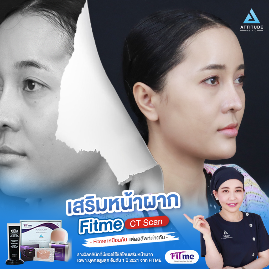 แก้ไขเสริมหน้าผาก Fitme