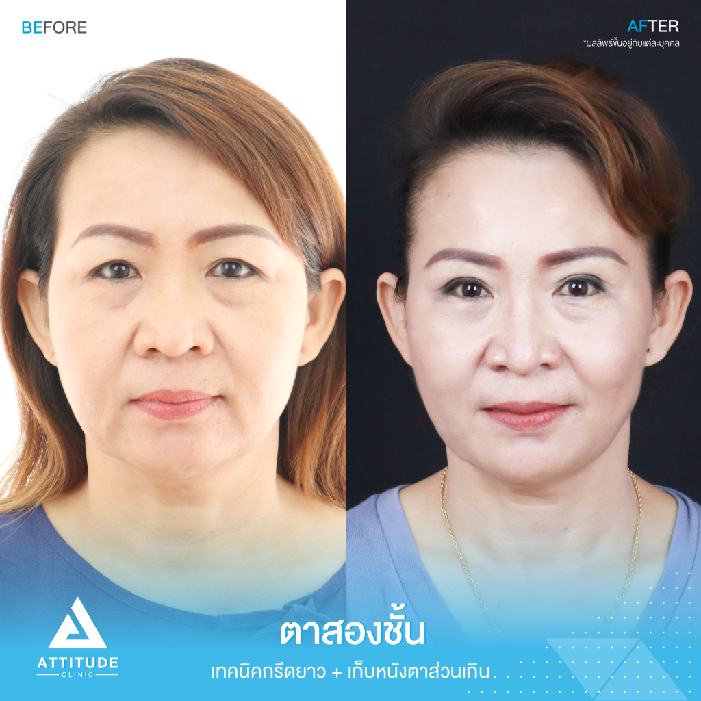 รีวิวทำตาสองชั้น เทคนิคกรีดยาว แก้ไขปัญหาหนังตาตก ให้ชั้นตาชัดเจน กระชากวัย โดยหมอยุ้ย Attitude Clinic รัชดา คุณหมอยุ้ย ใช้เทคนิค กรีดยาวเพื่อตัดหนังตาส่วนเกิน สร้างชั้นตาใหม่ และลดไขมันส่วนเกินออก จะทำให้ชั้นตาชัดเจนและชั้นตาจะอยู่ได้ในระยะยาว