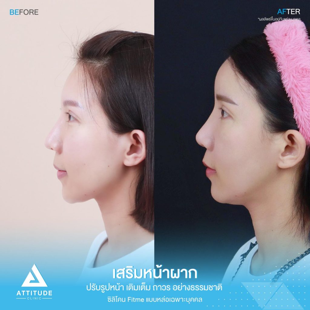 รีวิวเสริมหน้าผาก ด้วยซิลิโคน Fitme แบบแหล่อ เฉพาะบุคคล ปรับหน้าผากให้เต็มหวานละมุนขึ้น โหวงเฮ้งปังรับทรัพย์ โดยหมอยุ้ย Attitude Clinic เชียงราย