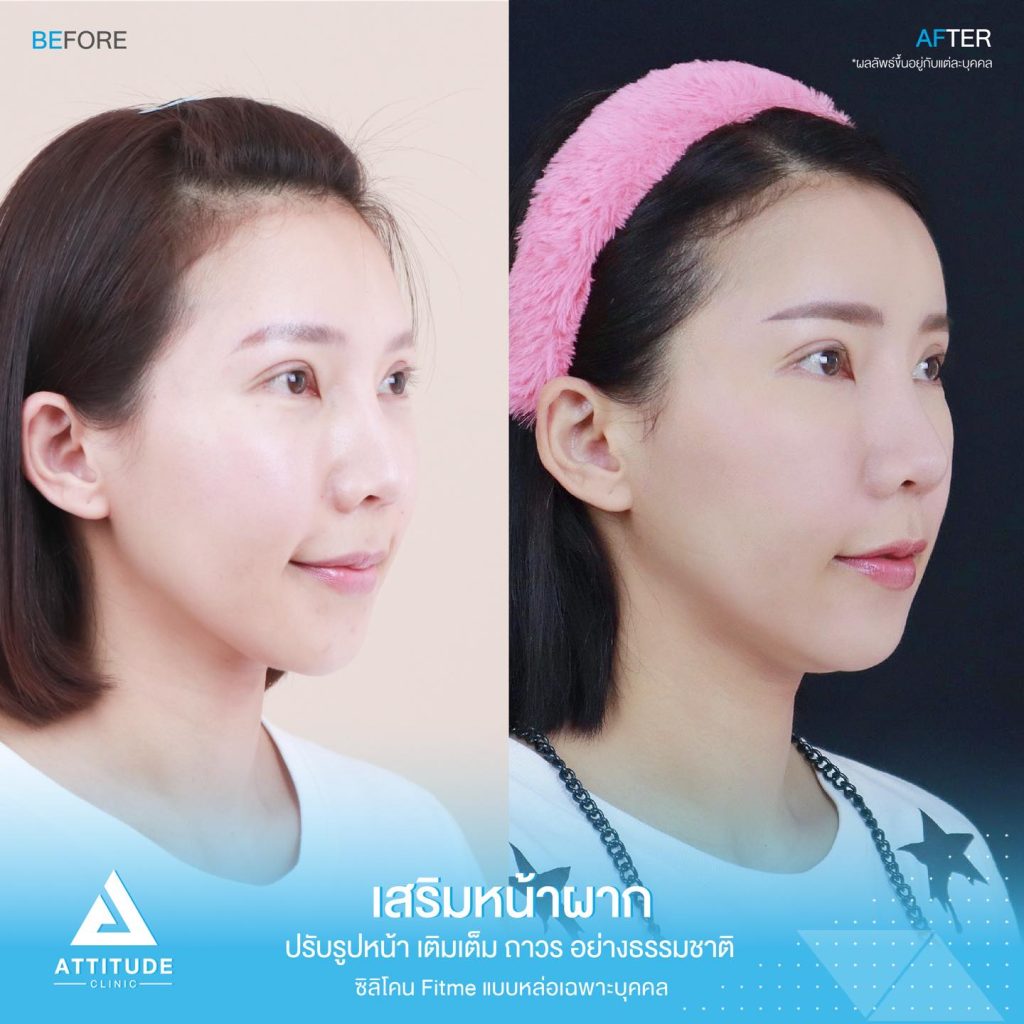 รีวิวเสริมหน้าผาก ด้วยซิลิโคน Fitme แบบแหล่อ เฉพาะบุคคล ปรับหน้าผากให้เต็มหวานละมุนขึ้น โหวงเฮ้งปังรับทรัพย์ โดยหมอยุ้ย Attitude Clinic เชียงราย