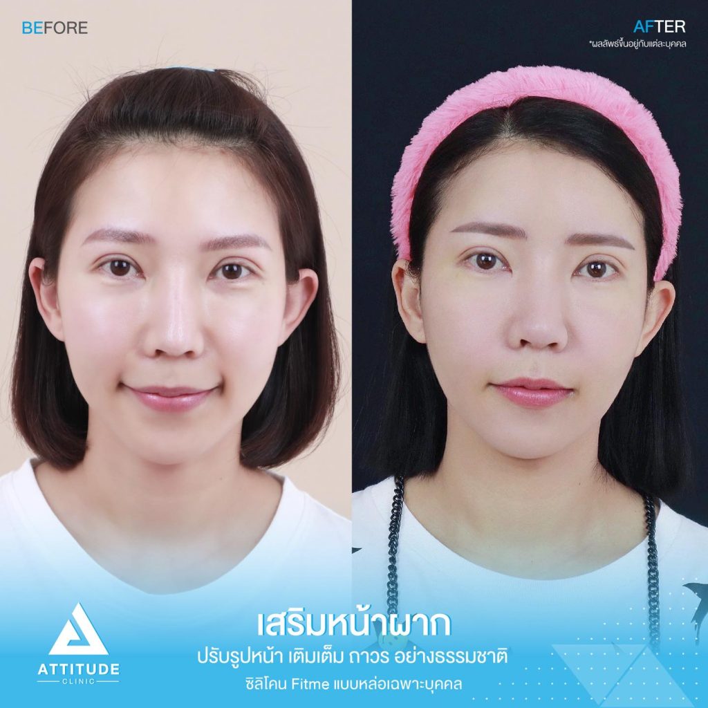 รีวิวเสริมหน้าผาก ด้วยซิลิโคน Fitme แบบแหล่อ เฉพาะบุคคล ปรับหน้าผากให้เต็มหวานละมุนขึ้น โหวงเฮ้งปังรับทรัพย์ โดยหมอยุ้ย Attitude Clinic เชียงราย
