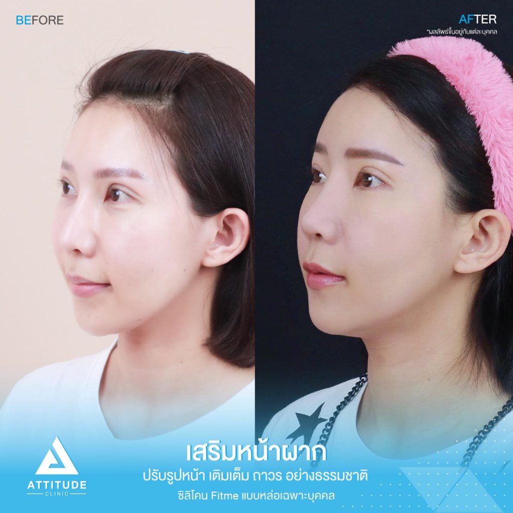 รีวิวเสริมหน้าผาก ด้วยซิลิโคน Fitme แบบแหล่อ เฉพาะบุคคล ปรับหน้าผากให้เต็มหวานละมุนขึ้น โหวงเฮ้งปังรับทรัพย์ โดยหมอยุ้ย Attitude Clinic เชียงราย