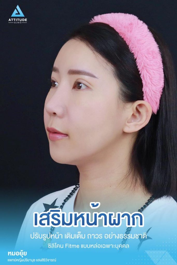 รีวิวเสริมหน้าผาก ด้วยซิลิโคน Fitme แบบแหล่อ เฉพาะบุคคล ปรับหน้าผากให้เต็มหวานละมุนขึ้น โหวงเฮ้งปังรับทรัพย์ โดยหมอยุ้ย Attitude Clinic เชียงราย