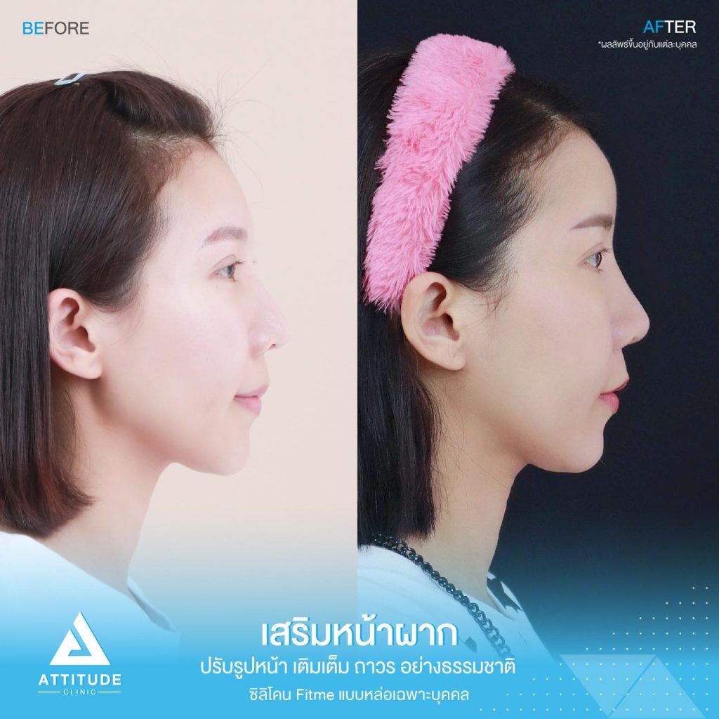 รีวิวเสริมหน้าผาก ด้วยซิลิโคน Fitme แบบแหล่อ เฉพาะบุคคล ปรับหน้าผากให้เต็มหวานละมุนขึ้น โหวงเฮ้งปังรับทรัพย์ โดยหมอยุ้ย Attitude Clinic เชียงราย