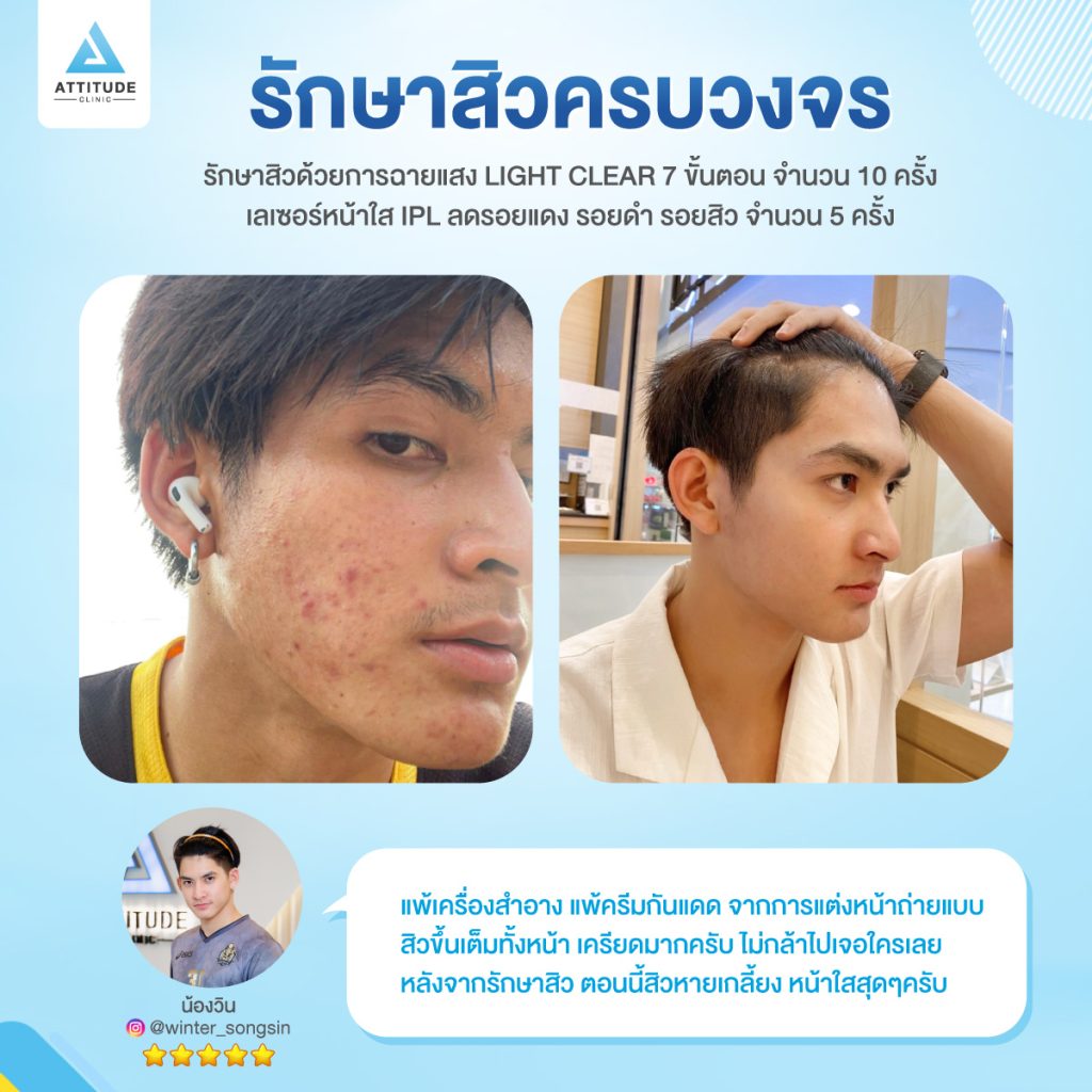 วิธีการกดสิวที่ถูกต้อง ด้วยการกดสิวตามแนวรูขุมขนคืออะไร ? แอททิจูดคลินิกมีคำตอบ กดสิว รักษาสิว ต้องที่แอททิจูดคลินิก Attitude Clinic สาขาเชียงราย เชียงใหม่ ลำปาง