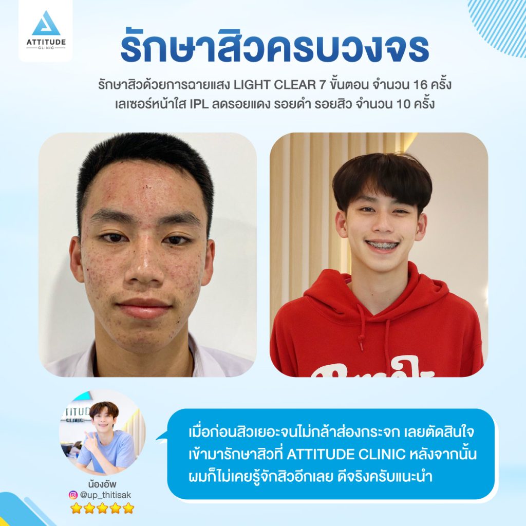 วิธีการกดสิวที่ถูกต้อง ด้วยการกดสิวตามแนวรูขุมขนคืออะไร ? แอททิจูดคลินิกมีคำตอบ กดสิว รักษาสิว ต้องที่แอททิจูดคลินิก Attitude Clinic สาขาเชียงราย เชียงใหม่ ลำปาง