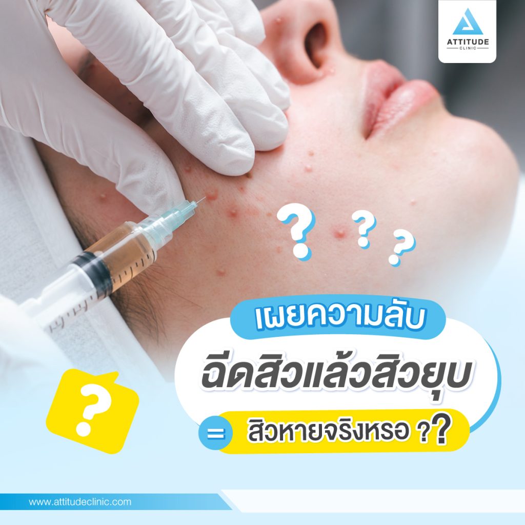 เผยความลับ ฉีดสิวแล้วสิวยุบ = สิวหายจริงหรอ?  การฉีดสิว แพทย์จะฉีดเฉพาะจุดที่เป็นสิวอักเสบ คือ สิวที่ติดเชื้อ P.Acnes มีอาการเจ็บ บวมแดง บางรายอาจจะมีหนองขึ้นตรงบริเวณตุ่มสิว แพทย์จะฉีดสิวให้โดยใช้ยาสเตียรอยด์ฉีดสิว ซึ่งมีคุณสมบัติลดการปวด บวม และอักเสบ ซึ่งสเตียรอยด์ ไม่มีคุณสมบัติในการฆ่าเชื้อสิวแต่อย่างใด Atttiude clinic เชียงราย เชียงใหม่ ลำปาง