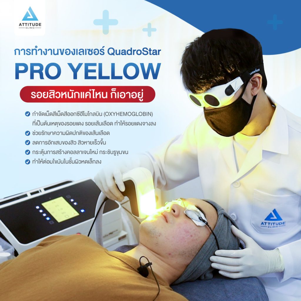 การทำงานของเลเซอร์ Pro Yellow ที่ Attitude clinic วัตกรรมเลเซอร์สีเหลืองจากเยอรมัน รับรองประสิทธิภาพในการรักษาอย่างดี มีความยาวคลื่น 577 นาโนเมตร สามารถถูกดูดซับได้ดีในเม็ดเลือดแดง จึงนำมาใช้ในการรักษารอยโรคที่เกิดจากเส้นเลือด เช่น เส้นเลือดฝอยขยาย หน้าแดง ผื่นแดง การอักเสบของสิว รอยแดงสิว และสามารถแก้ปัญหาได้ตรงจุดกว่าเลเซอร์ชนิดอื่นทั่วไป เช่น IPL