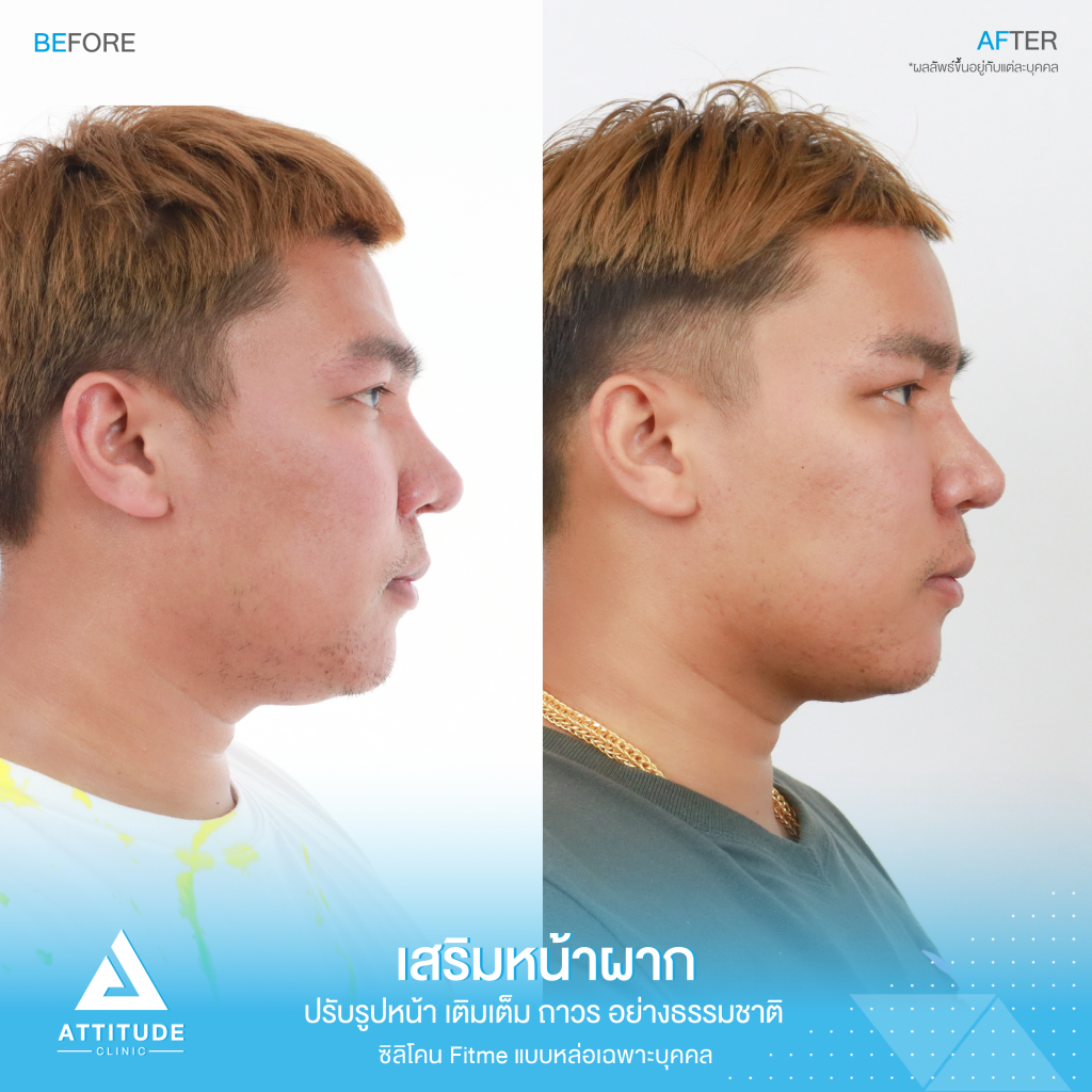 รีวิวเสริมหน้าผากผู้ชาย ด้วยซิลิโคน Fitme แบบแหล่อ เฉพาะบุคคล เติมเต็มหน้าผาก ปรับรูปหน้าอย่างเป็นธรรมชาติ โดยหมอยุ้ย Attitude Clinic รัชดา รีวิวเยอะที่สุด หมออยู่ประจำ ทำเองทุกเคส