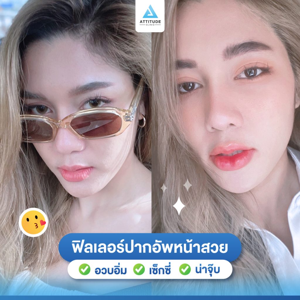 ฉีดฟิลเลอร์เชียงใหม่ เชียงราย ลำปาง