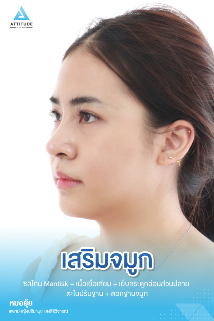 รีวิวเสริมจมูกผู้หญิง