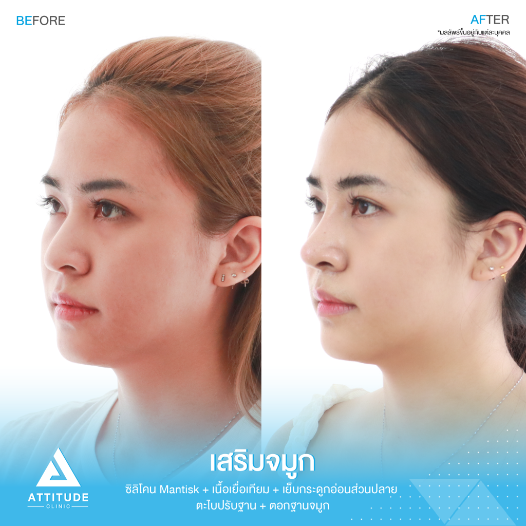 รีวิวเสริมจมูกผู้หญิง ด้วยซิลิโคน Mantisk ปรับทรงจมูกใหม่จากปลายงุ้ม ให้เชิดสันจมูกโค้งโดยคุณหมอยุ้ย Attitude Clinic รัชดา ก่อนเสริมจมูก ลูกค้ามีฐานจมูกพอสมควร แต่ปลายจมูกค่อนข้างงุ้ม ปลายตกทำให้ใบหน้าดูดุ ไม่มีมีติ ที่ชัดเจน