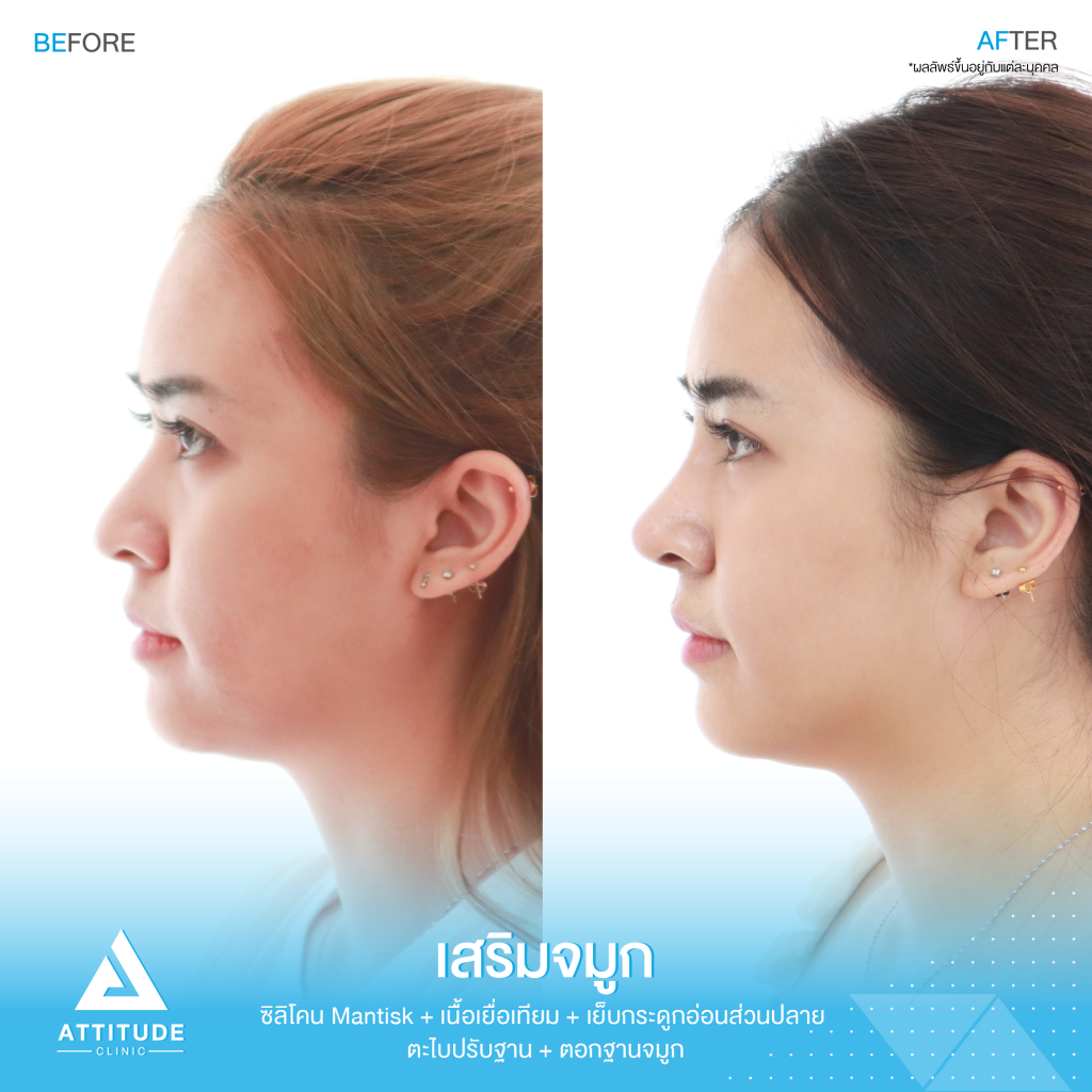 รีวิวเสริมจมูกผู้หญิง ด้วยซิลิโคน Mantisk ปรับทรงจมูกใหม่จากปลายงุ้ม ให้เชิดสันจมูกโค้งโดยคุณหมอยุ้ย Attitude Clinic รัชดา ก่อนเสริมจมูก ลูกค้ามีฐานจมูกพอสมควร แต่ปลายจมูกค่อนข้างงุ้ม ปลายตกทำให้ใบหน้าดูดุ ไม่มีมีติ ที่ชัดเจน