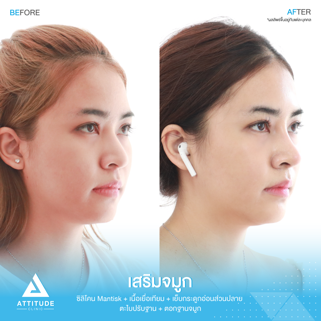 รีวิวเสริมจมูกผู้หญิง ด้วยซิลิโคน Mantisk ปรับทรงจมูกใหม่จากปลายงุ้ม ให้เชิดสันจมูกโค้งโดยคุณหมอยุ้ย Attitude Clinic รัชดา ก่อนเสริมจมูก ลูกค้ามีฐานจมูกพอสมควร แต่ปลายจมูกค่อนข้างงุ้ม ปลายตกทำให้ใบหน้าดูดุ ไม่มีมีติ ที่ชัดเจน