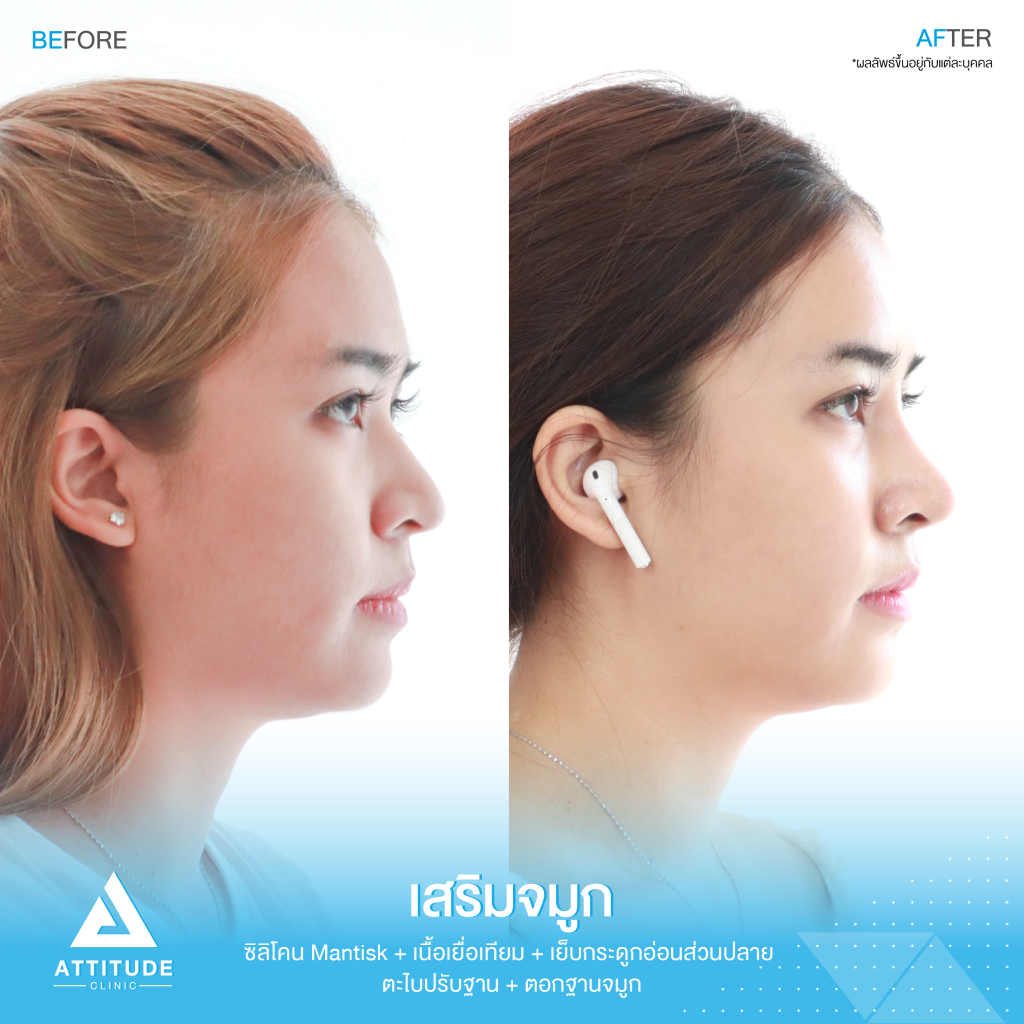 รีวิวเสริมจมูกผู้หญิง ด้วยซิลิโคน Mantisk ปรับทรงจมูกใหม่จากปลายงุ้ม ให้เชิดสันจมูกโค้งโดยคุณหมอยุ้ย Attitude Clinic รัชดา ก่อนเสริมจมูก ลูกค้ามีฐานจมูกพอสมควร แต่ปลายจมูกค่อนข้างงุ้ม ปลายตกทำให้ใบหน้าดูดุ ไม่มีมีติ ที่ชัดเจน