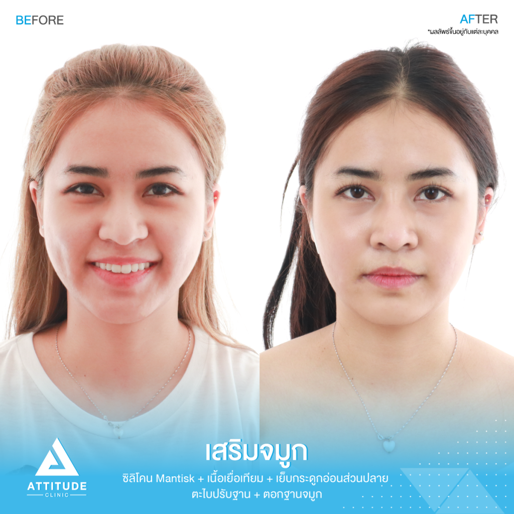 รีวิวเสริมจมูกผู้หญิง ด้วยซิลิโคน Mantisk ปรับทรงจมูกใหม่จากปลายงุ้ม ให้เชิดสันจมูกโค้งโดยคุณหมอยุ้ย Attitude Clinic รัชดา ก่อนเสริมจมูก ลูกค้ามีฐานจมูกพอสมควร แต่ปลายจมูกค่อนข้างงุ้ม ปลายตกทำให้ใบหน้าดูดุ ไม่มีมีติ ที่ชัดเจน
