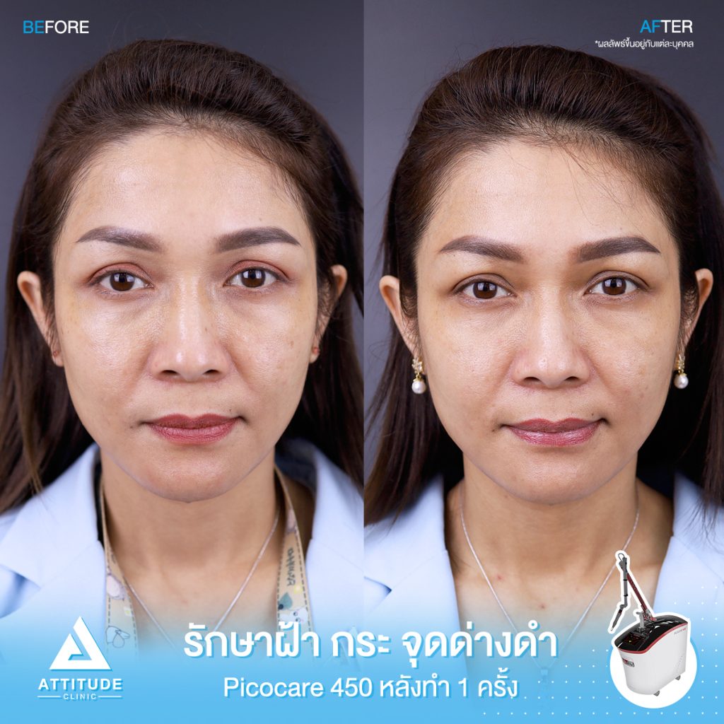 รีวิวรักษาฝ้า กระ จุดด่างดำ จำนวน 1 ครั้ง หลังทำ 1 เดือน ด้วยเครื่องเลเซอร์ Picocare450 นวัตกรรม Picosecond Laser ที่ Attitude Clinic เชียงราย นวัตกรรม Picosecond Laser ใหม่ล่าสุดมาตรฐาน ??US FDA ส่งพลังงานความเร็ว 1 ต่อล้านล้านวินาที สามารถยิงเม็ดสีแตกละเอียด กว่าเลเซอร์รุ่นเก่าๆ ถึง 1,000 เท่า 