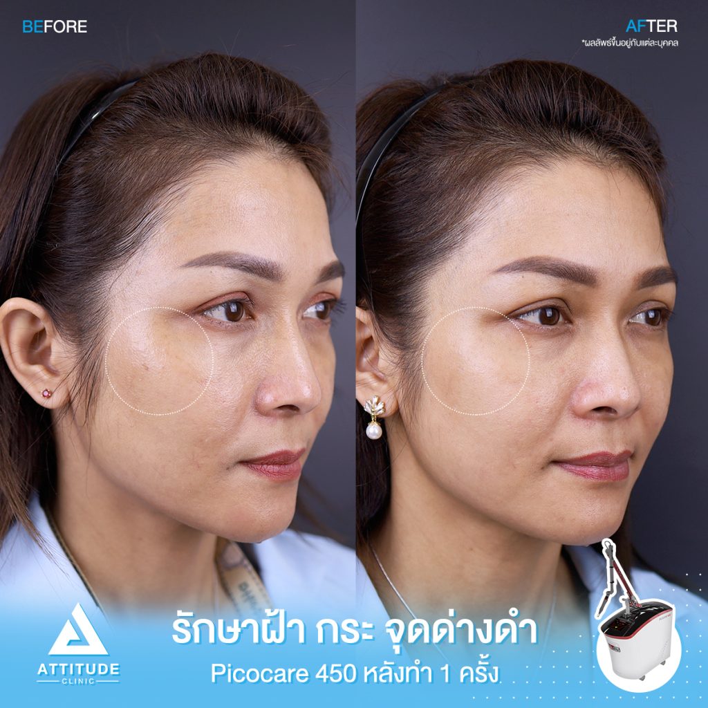 รีวิวรักษาฝ้า กระ จุดด่างดำ จำนวน 1 ครั้ง หลังทำ 1 เดือน ด้วยเครื่องเลเซอร์ Picocare450 นวัตกรรม Picosecond Laser ที่ Attitude Clinic เชียงราย นวัตกรรม Picosecond Laser ใหม่ล่าสุดมาตรฐาน ??US FDA ส่งพลังงานความเร็ว 1 ต่อล้านล้านวินาที สามารถยิงเม็ดสีแตกละเอียด กว่าเลเซอร์รุ่นเก่าๆ ถึง 1,000 เท่า 