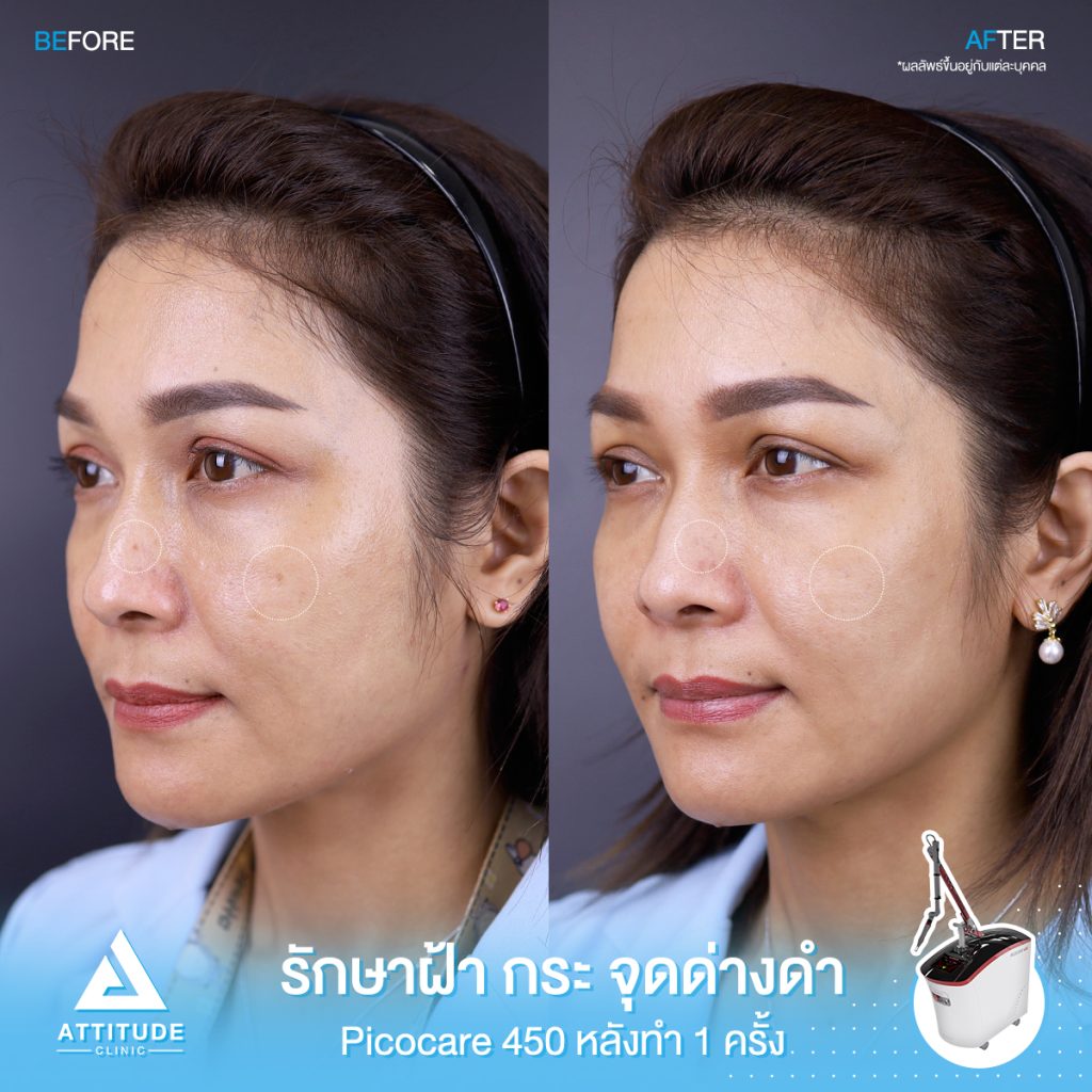 รีวิวรักษาฝ้า กระ จุดด่างดำ จำนวน 1 ครั้ง หลังทำ 1 เดือน ด้วยเครื่องเลเซอร์ Picocare450 นวัตกรรม Picosecond Laser ที่ Attitude Clinic เชียงราย นวัตกรรม Picosecond Laser ใหม่ล่าสุดมาตรฐาน ??US FDA ส่งพลังงานความเร็ว 1 ต่อล้านล้านวินาที สามารถยิงเม็ดสีแตกละเอียด กว่าเลเซอร์รุ่นเก่าๆ ถึง 1,000 เท่า 